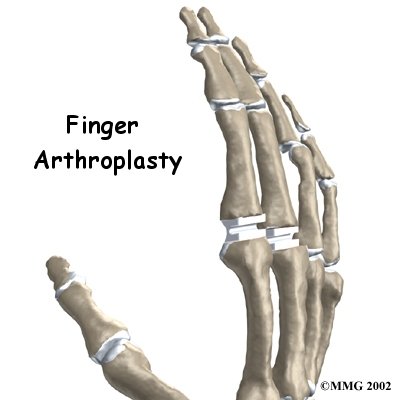 Artificial Joint Replacement of the Finger - Therapy Specialists Inc's Guide